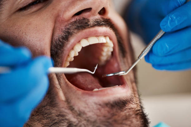 Best Emergency Dental Care for Broken or Chipped Teeth in Kenmore, WA